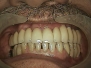 Complex rehabilitation on teeth and implants