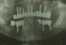 After - X-Ray