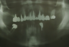 Before - X-Ray