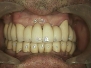 Complex rehabilitation on teeth and implants
