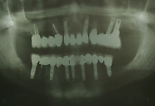 After - X-Ray