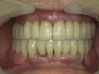 Complex rehabilitation on teeth