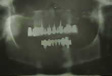 After - X-ray