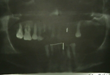 Before - X-ray