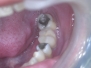 Replacement of missing piece with a single implant (molar)
