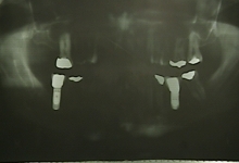 After - X-rays