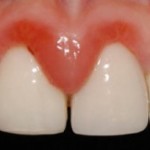 preop-gingivitis-1-300x164